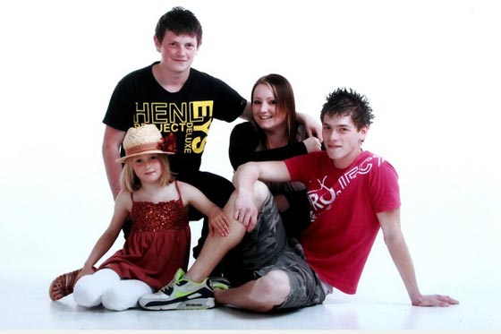 السجائر تسببت في بتر ساقيها.. فسارعت للتحذير منها بصورتها صورة رقم 4