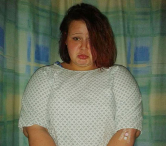 تحذير: صور مروعة لاصبع مراهقة التهب بسبب الصاق اظافر مستعارة  صورة رقم 2