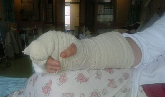 تحذير: صور مروعة لاصبع مراهقة التهب بسبب الصاق اظافر مستعارة  صورة رقم 4