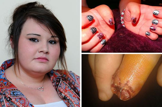 تحذير: صور مروعة لاصبع مراهقة التهب بسبب الصاق اظافر مستعارة  صورة رقم 1