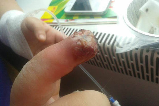 تحذير: صور مروعة لاصبع مراهقة التهب بسبب الصاق اظافر مستعارة  صورة رقم 7