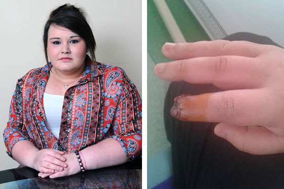 تحذير: صور مروعة لاصبع مراهقة التهب بسبب الصاق اظافر مستعارة  صورة رقم 8