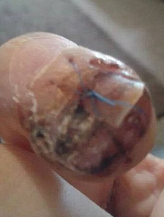 تحذير: صور مروعة لاصبع مراهقة التهب بسبب الصاق اظافر مستعارة  صورة رقم 9