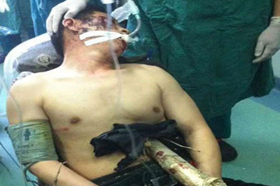 عامود خشبي طوله 6 أمتار يخترق جسد رجل ويبقيه على قيد الحياة صورة رقم 2