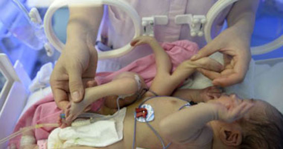 ازالة الأطراف الزائدة لطفل ولد بـ 4 اياد و 4 أرجل صورة رقم 1