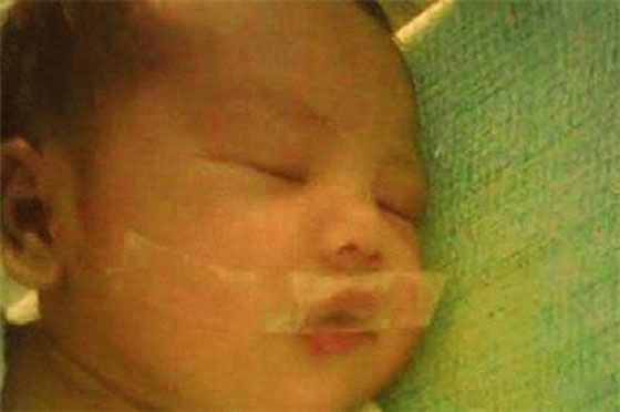 لماذا وضعت الممرضة الشريط اللاصق على فم المولود الجديد؟ صورة رقم 2