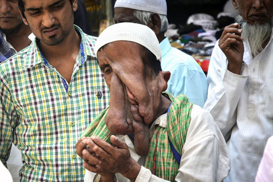  صور قاسية لرجل مشوه الوجه يرفض عملية جراحية مجانية ليستمر في التسول  صورة رقم 3