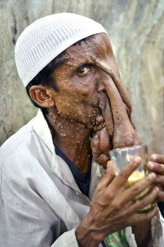  صور قاسية لرجل مشوه الوجه يرفض عملية جراحية مجانية ليستمر في التسول  صورة رقم 4