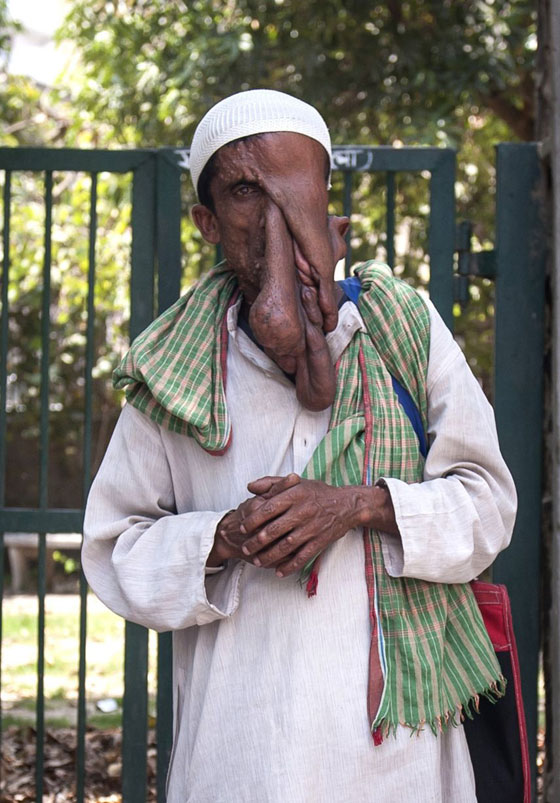  صور قاسية لرجل مشوه الوجه يرفض عملية جراحية مجانية ليستمر في التسول  صورة رقم 5