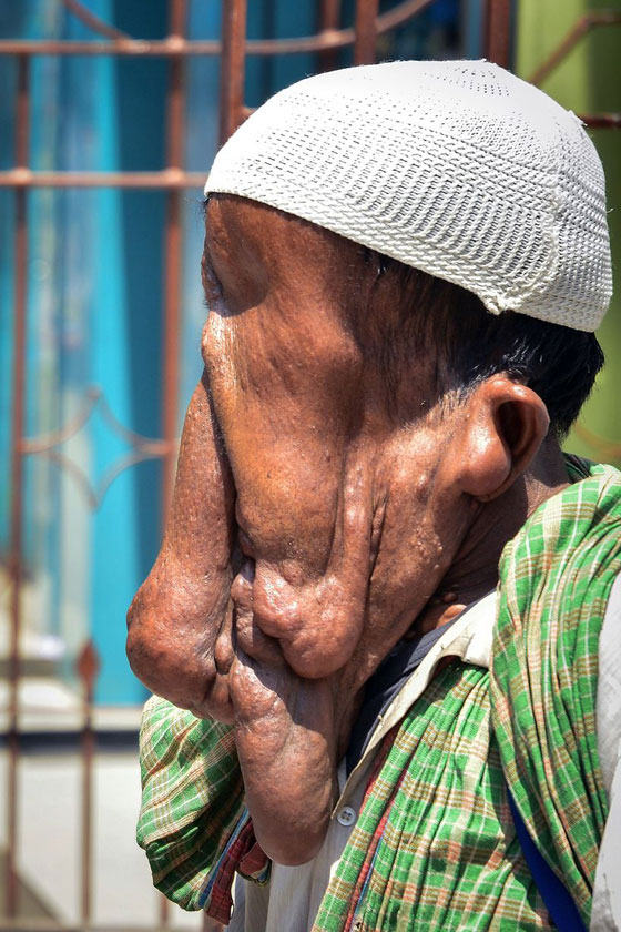  صور قاسية لرجل مشوه الوجه يرفض عملية جراحية مجانية ليستمر في التسول  صورة رقم 8
