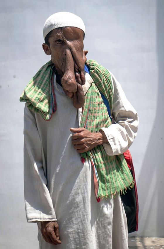  صور قاسية لرجل مشوه الوجه يرفض عملية جراحية مجانية ليستمر في التسول  صورة رقم 9