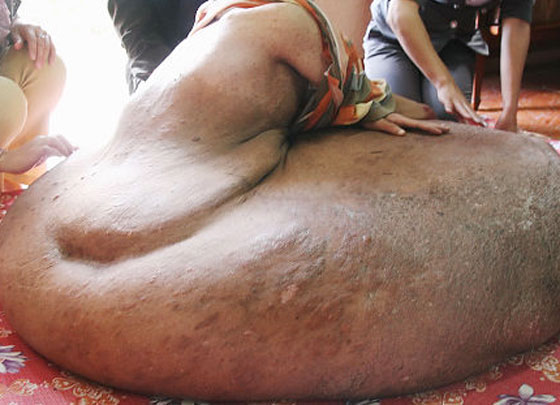 استئصال أكبر ورم سرطاني بتاريخ الطب وزنه 110 كغم  صورة رقم 1