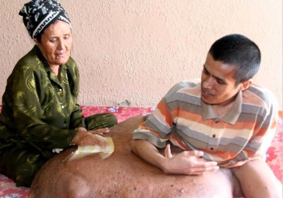 استئصال أكبر ورم سرطاني بتاريخ الطب وزنه 110 كغم  صورة رقم 4