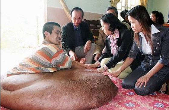 استئصال أكبر ورم سرطاني بتاريخ الطب وزنه 110 كغم  صورة رقم 5