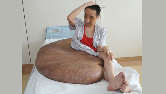 استئصال أكبر ورم سرطاني بتاريخ الطب وزنه 110 كغم  صورة رقم 6