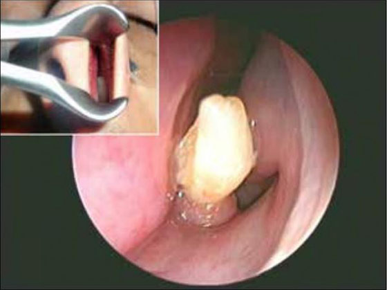 حالة نادرة.. اقتلاع سن من انف شاب سعودي صورة رقم 1