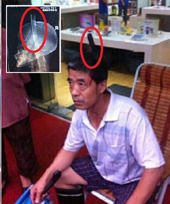 بالصور.. سكين يسقط من الطابق الثامن لينغرس في رأس رجل صيني صورة رقم 2