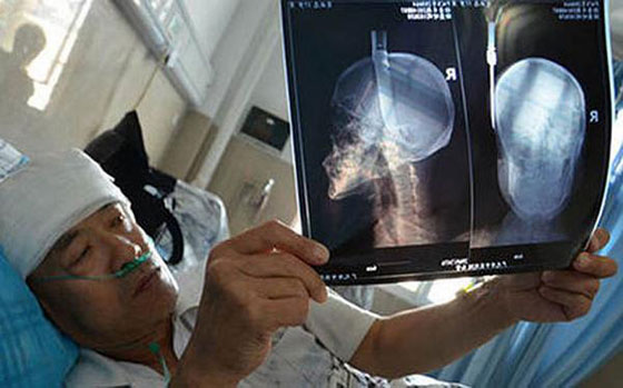 بالصور.. سكين يسقط من الطابق الثامن لينغرس في رأس رجل صيني صورة رقم 1