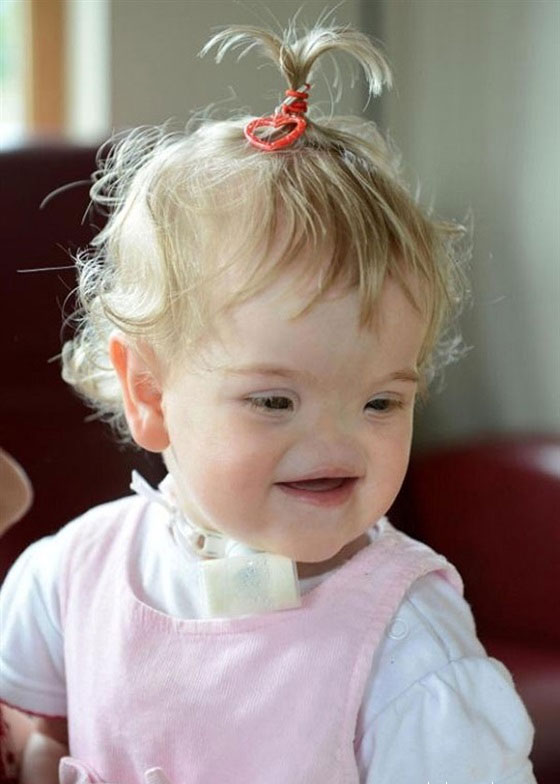 حالة نادرة.. طفلة ايرلندية بدون انف!! صورة رقم 1