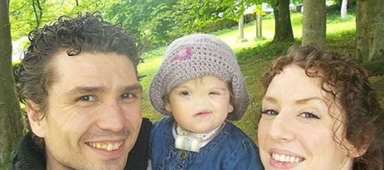 حالة نادرة.. طفلة ايرلندية بدون انف!! صورة رقم 2