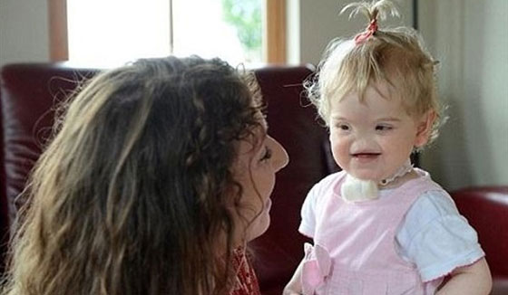 حالة نادرة.. طفلة ايرلندية بدون انف!! صورة رقم 3