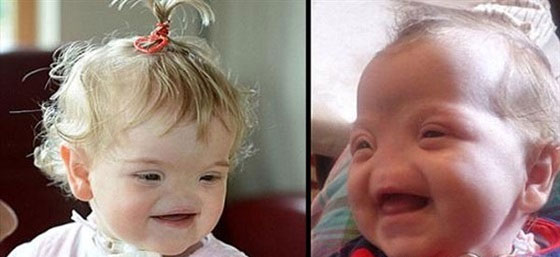 حالة نادرة.. طفلة ايرلندية بدون انف!! صورة رقم 4