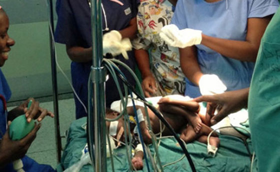 بالصور.. ولادة طفل باربع ارجل وأربع أذرع في اوغندا صورة رقم 1