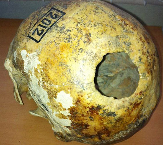 بالصور.. جمجمة بشرية تثبت ان القدماء برعوا في جراحة المخ صورة رقم 1