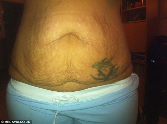 السمنة الزائدة تتسبب بتأجيل عروس لزفافها مدة 17 عاما!! صورة رقم 10