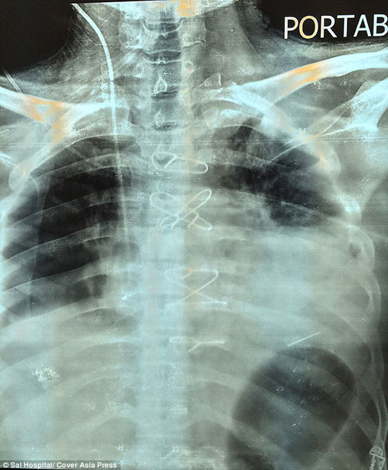 بالصور.. عاش لمدة شهرين مع رصاصة في القلب صورة رقم 3