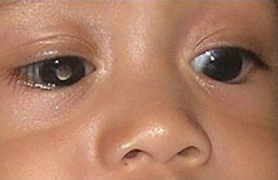 قمة التضحية.. والدان يتبرع كل منهما بعين لكي يرى ابنهما النور صورة رقم 1