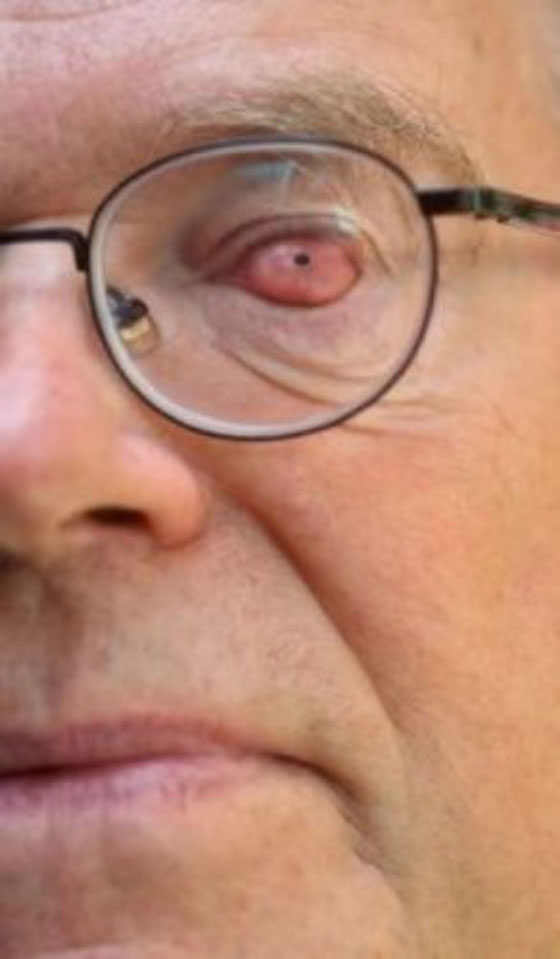 السن بالعين.. ضرير الماني يرى النور من خلال ناب زرع في عينه! صورة رقم 2