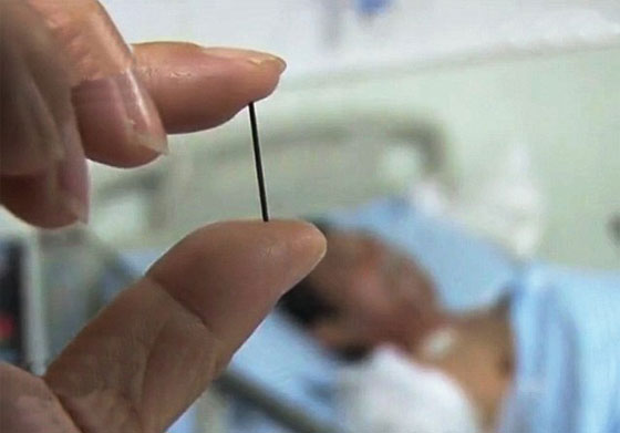 معاناة اربعين عاما تنتهي باكتشاف ابرة منغرسة في الاحشاء!! صورة رقم 2