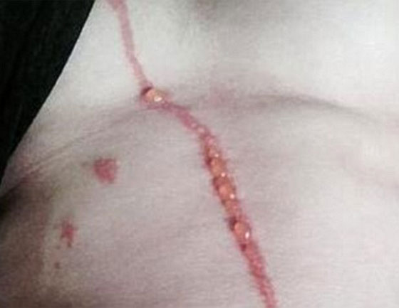 بالصور.. عنكبوت يتسلل الى بطن استرالي في بالي ويستوطن فيه صورة رقم 4