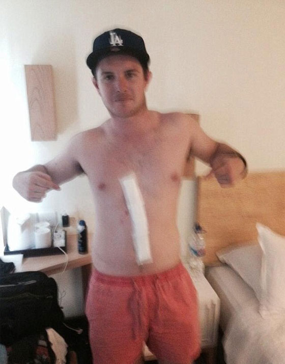 بالصور.. عنكبوت يتسلل الى بطن استرالي في بالي ويستوطن فيه صورة رقم 1