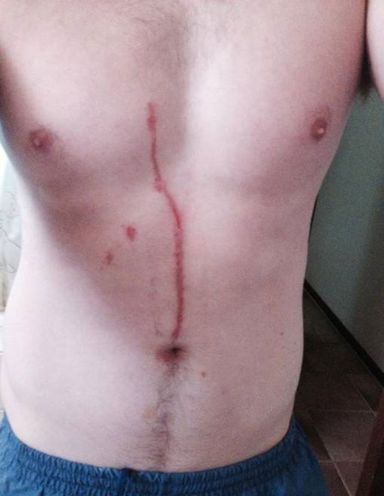 بالصور.. عنكبوت يتسلل الى بطن استرالي في بالي ويستوطن فيه صورة رقم 2