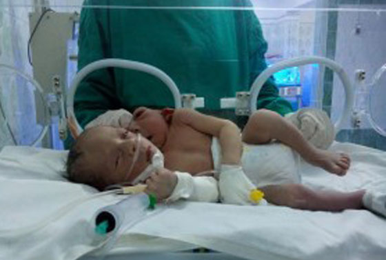 وفاة المولود برأسين وقلبين وثلاثة اذرع في مصر صورة رقم 2