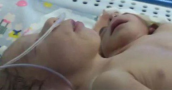  وفاة المولود برأسين وقلبين وثلاثة اذرع في مصر صورة رقم 1