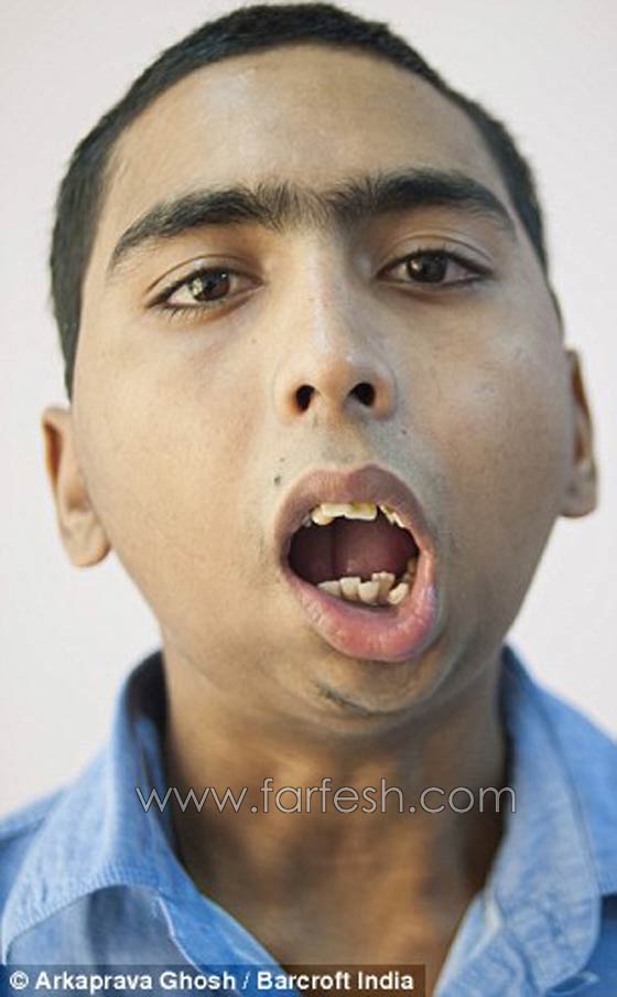 هندي يفتح فمه لاول منذ 8 سنوات بعد حالة تشنج بسبب صدمة صورة رقم 4