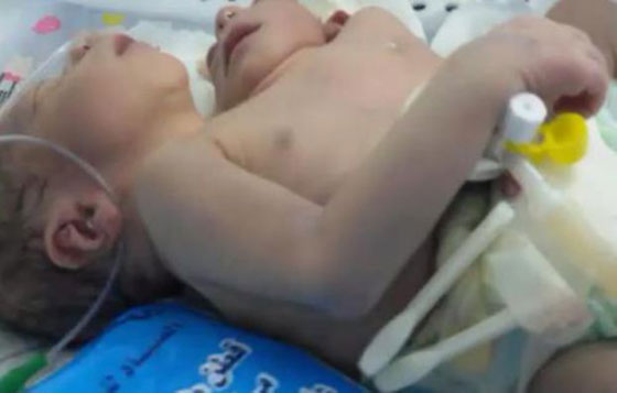 امرأة مصرية تضع مولودا برأسين وقلبين وثلاثة أذرع صورة رقم 1