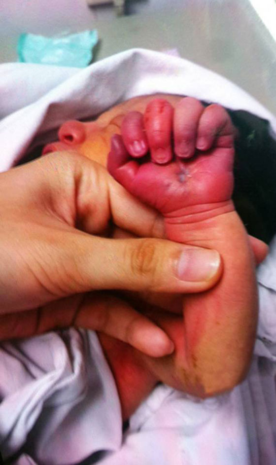 بالصور.. أم تنهش يد مولودها البالغ 3 ايام وتشوهها صورة رقم 2