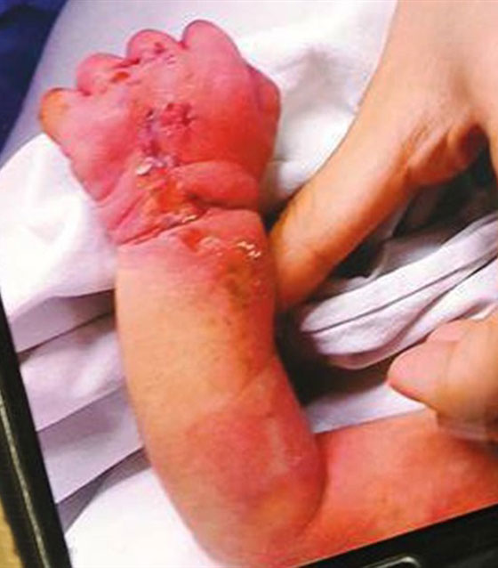 بالصور.. أم تنهش يد مولودها البالغ 3 ايام وتشوهها صورة رقم 3