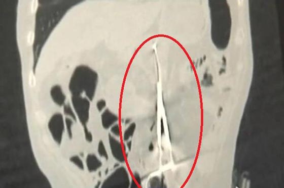  صدمة.. العثور على مقص الجراحة في معدة مريض منذ 12 عاما صورة رقم 1