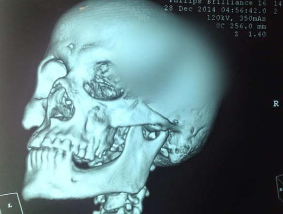 بقي السكين في رأسه مدة ساعتين بعد طعنه.. وكتبت له الحياة باعجوبة صورة رقم 2