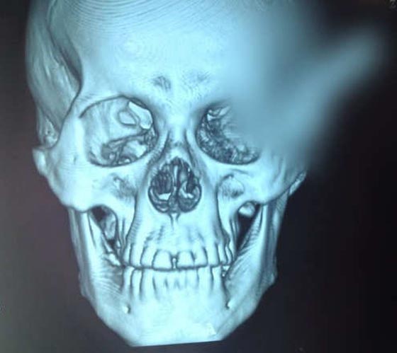 بقي السكين في رأسه مدة ساعتين بعد طعنه.. وكتبت له الحياة باعجوبة صورة رقم 4