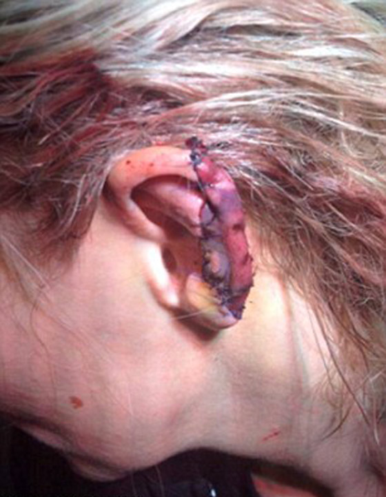 امرأة تقضم اذن أخرى في شجار داخل حانة بسبب كأس بيرة صورة رقم 3