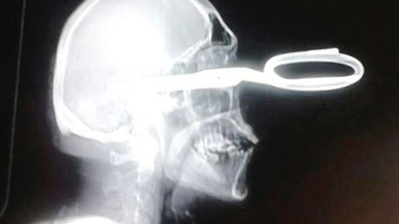 جاء للطبيب والمقص منغرز في رأسه يشكو من مشكلة بسيطة! صورة رقم 1