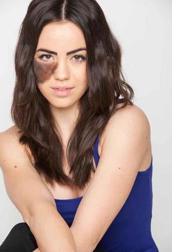 لهذا السبب تحولت عاهة راقصة استعراضية الى مصدر فخر واعتزاز.. صورة رقم 1 لهذا السبب تحولت عاهة راقصة استعراضية الى مصدر فخر واعتزاز.. صورة رقم 1