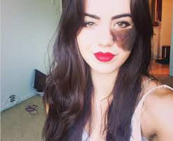 لهذا السبب تحولت عاهة راقصة استعراضية الى مصدر فخر واعتزاز.. صورة رقم 13 لهذا السبب تحولت عاهة راقصة استعراضية الى مصدر فخر واعتزاز.. صورة رقم 13