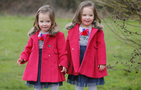 توأم ملتصق تتشابهان في كل شيء رغم فصلهما عند الولادة صورة رقم 6 توأم ملتصق تتشابهان في كل شيء رغم فصلهما عند الولادة صورة رقم 6